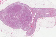 Adrenal cortical adenoma