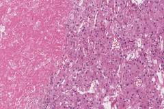 Adrenal cortical carcinoma: Tumour necrosis