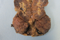 Adrenocortical carcinoma