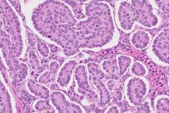 Adult type granulosa cell tumour