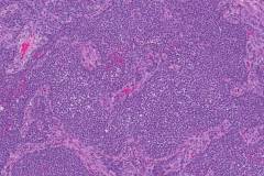 Adult type granulosa cell tumour of the ovary