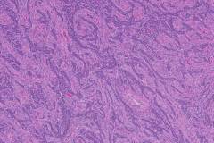 Adult type granulosa cell tumour of the ovary