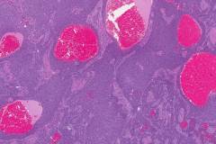 Adult type granulosa cell tumour of the ovary