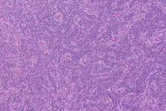 Adult type granulosa cell tumour of the ovary