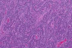 Adult type granulosa cell tumour of the ovary