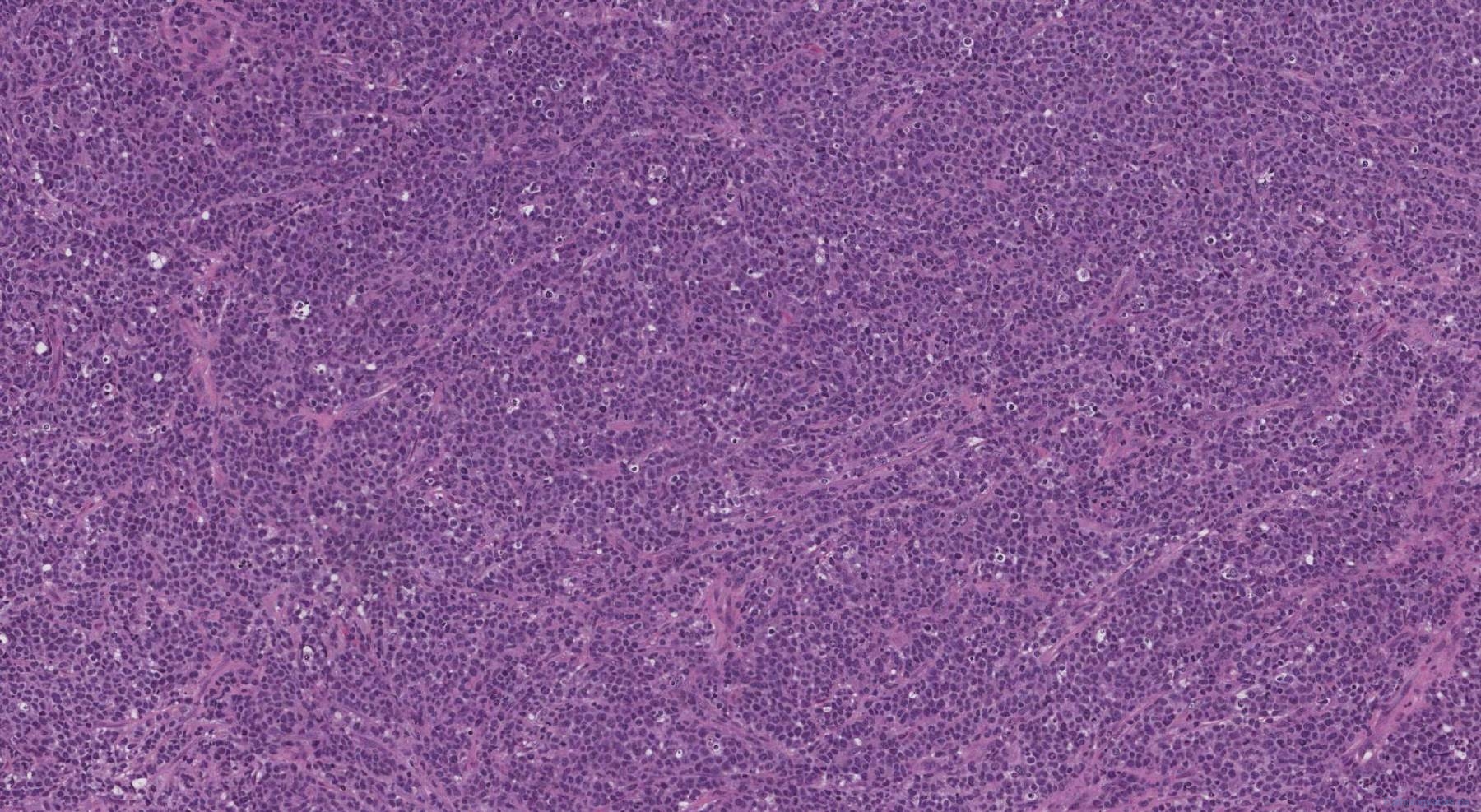 ALK-negative Anaplastic Large Cell Lymphoma | Ottawa Atlas Of Pathology