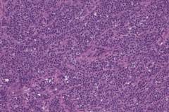 ALK-negative anaplastic large T cell lymphoma