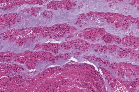 Allergic fungal rhinosinusitis | Atlas of Pathology