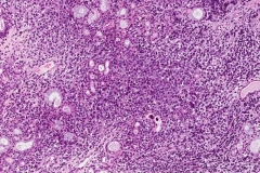 Alveolar rhabdomyosarcoma