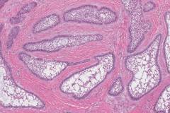 Follicular type ameloblastoma