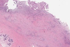 Ameloblastoma arising in the background of a radicular cyst