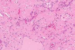 Amyloidoma of the thyroid gland