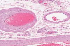 Amyloidosis of the small intestine