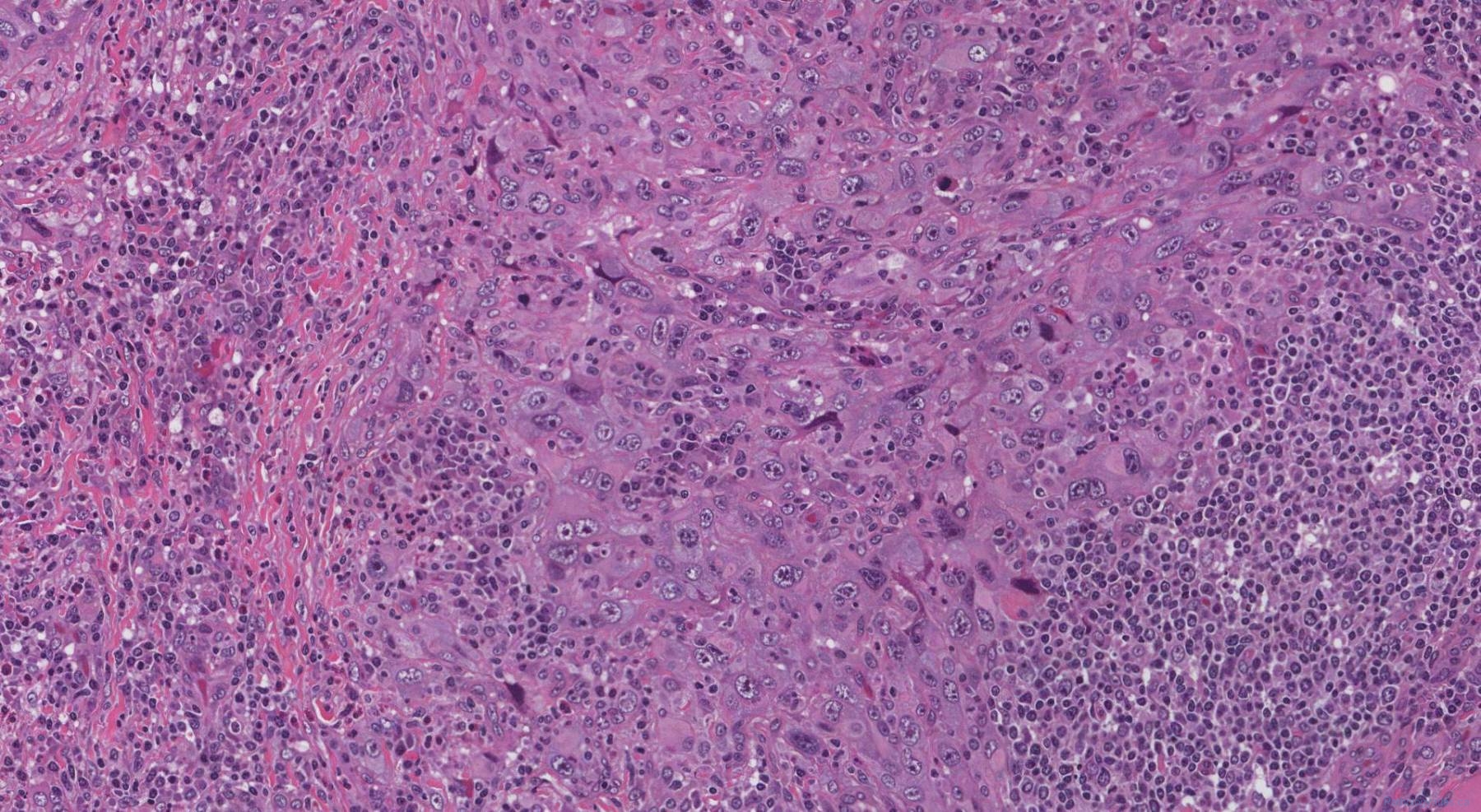 Anaplastic thyroid carcinoma | Ottawa Atlas of Pathology