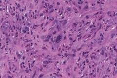 Anaplastic thyroid carcinoma