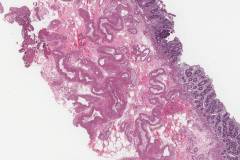 Angiodysplasia of the colon