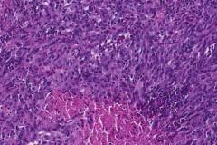 Pleomorphic angiosarcoma of the skin