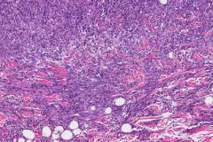 Pleomorphic angiosarcoma of the skin