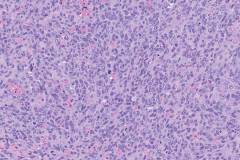 Angiosarcoma