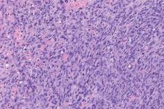 Angiosarcoma