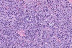 Angiosarcoma