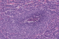 Atypical carcinoid tumour of the lung