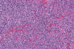 Atypical carcinoid tumour of the lung