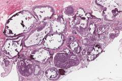 Atypical ductal hyperplasia of the breast