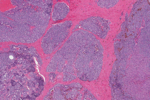 Atypical Parathyroid Adenoma Atlas Of Pathology