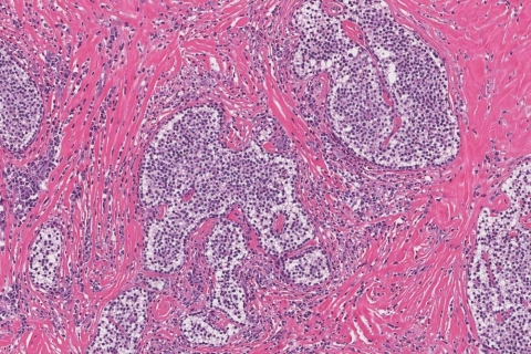 Atypical parathyroid adenoma | Atlas of Pathology