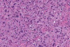 Atypical parathyroid adenoma