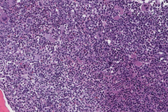 B lymphoblastic leukemia