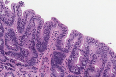 Barrett's esophagus with low grade dysplasia