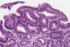 Barrett's esophagus with low grade dysplasia