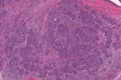 Basal cell adenocarcinoma of the parotid gland