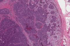 Basal cell adenocarcinoma of the parotid gland