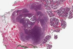 Basal cell adenocarcinoma of the parotid gland