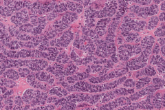 Basal cell adenocarcinoma