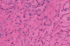 Basal cell adenocarcinoma