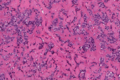 Basal cell adenocarcinoma