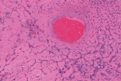 Basal cell adenocarcinoma