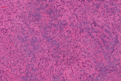 Basal cell adenocarcinoma