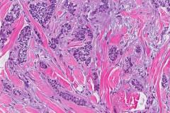 Infiltrative basal cell carcinoma of the skin