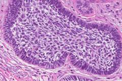 Micronodular basal cell carcinoma of the skin