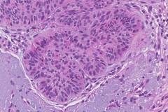 Nodular basal cell carcinoma of the skin