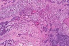 Nodular basal cell carcinoma of the skin