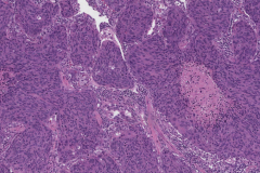 Basaloid squamous cell carcinoma of the lung