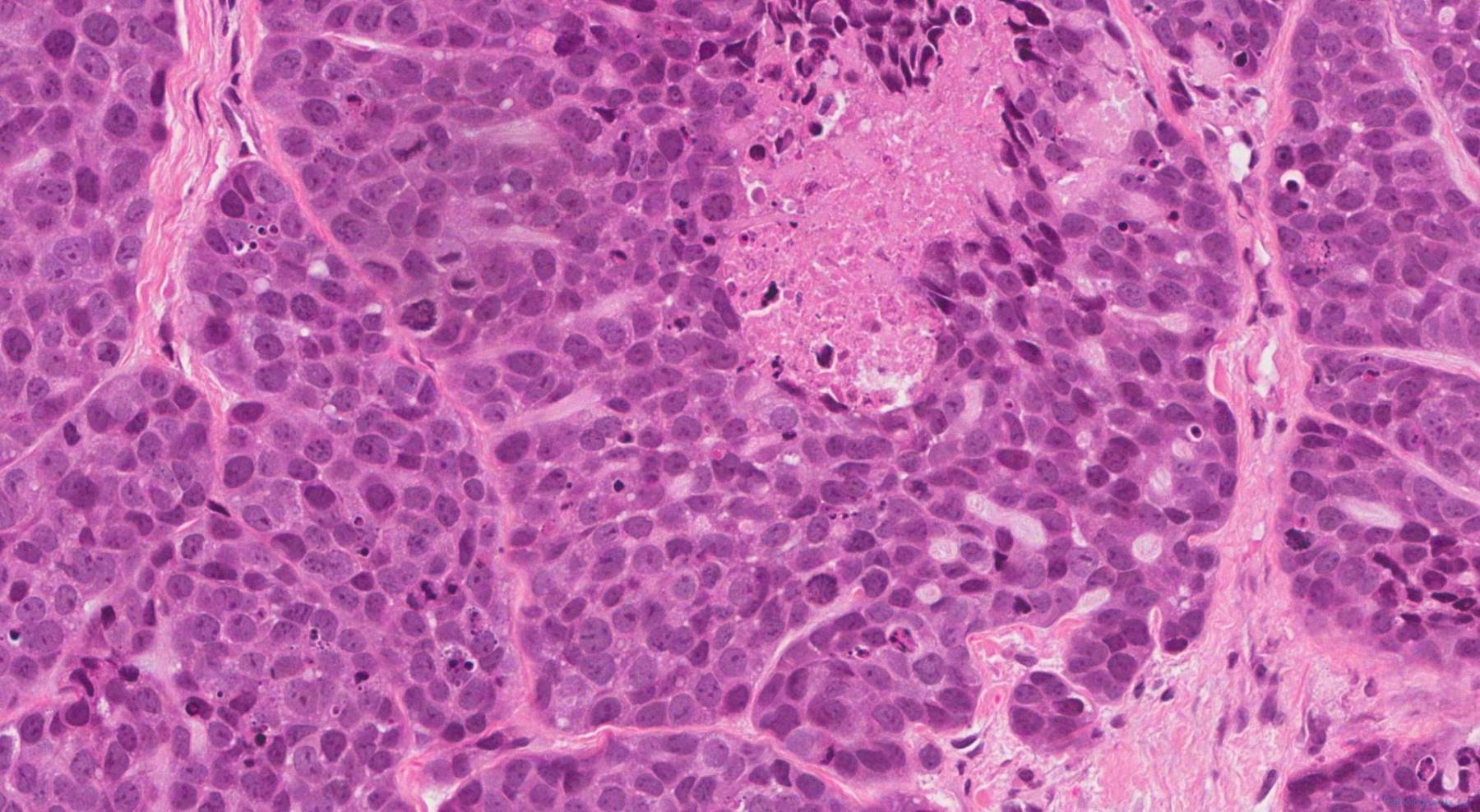 Basaloid squamous cell carcinoma of the larynx | Atlas of Pathology