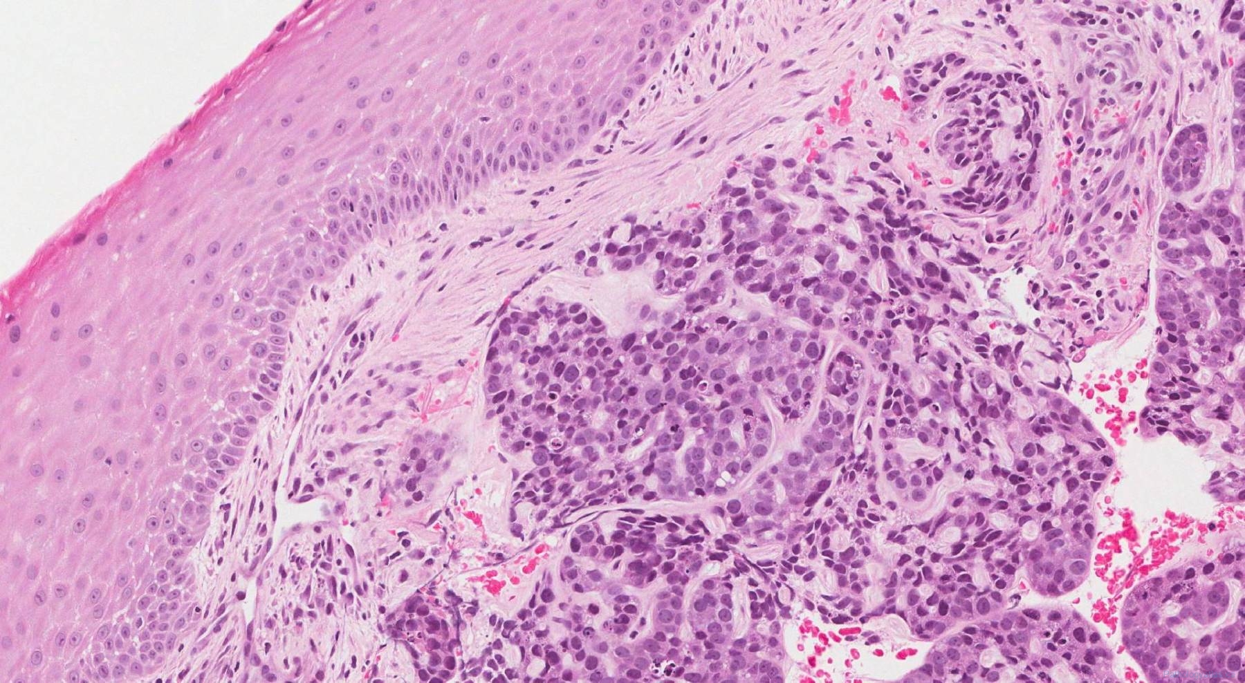 Basaloid squamous cell carcinoma of the larynx | Atlas of Pathology
