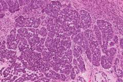 Basaloid squamous cell carcinoma of the larynx